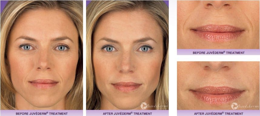 Juvederm before and after photo in Chicago, IL