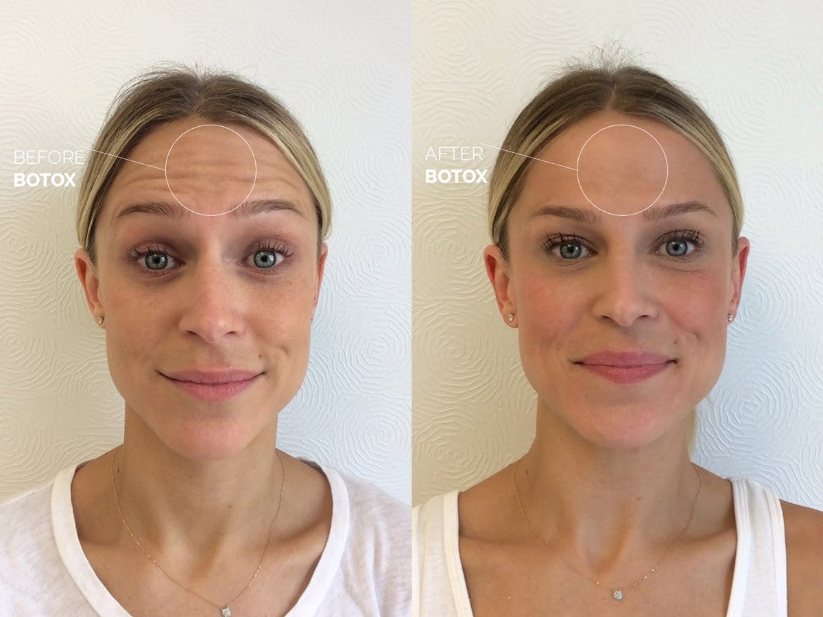 Botox Before and After Photo by Dr. Erickson in Chicago, IL Botox Before and After Photo by Dr. Erickson in Chicago, IL