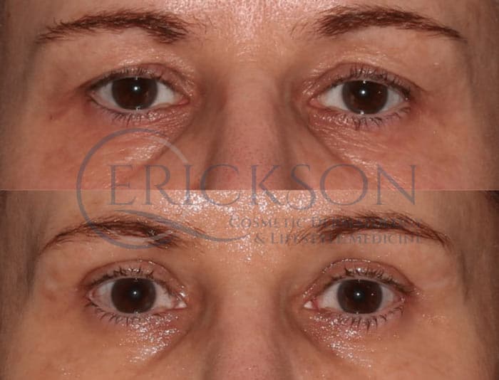blepharoplasty patient before and after photograph blepharoplasty patient before and after photograph