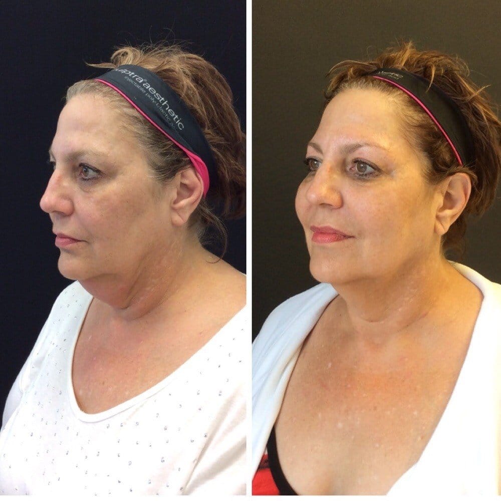 Kybella before after photo by Dr. Quenby Erickson in Chicago, IL