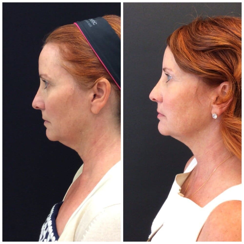 Kybella before after photo by Dr. Quenby Erickson in Chicago, IL