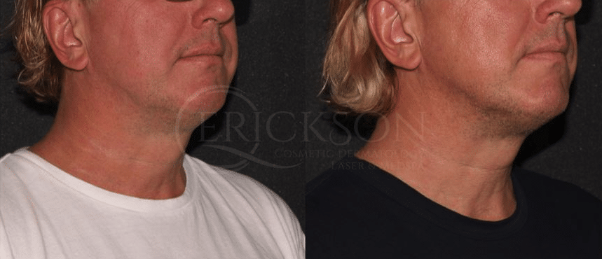 CoolSculpting before and after image