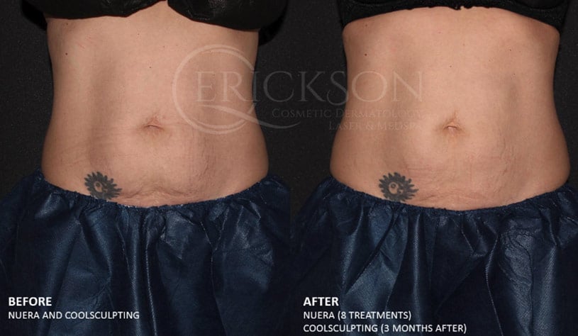 nuera tight before and after photo nuera tight before and after photo