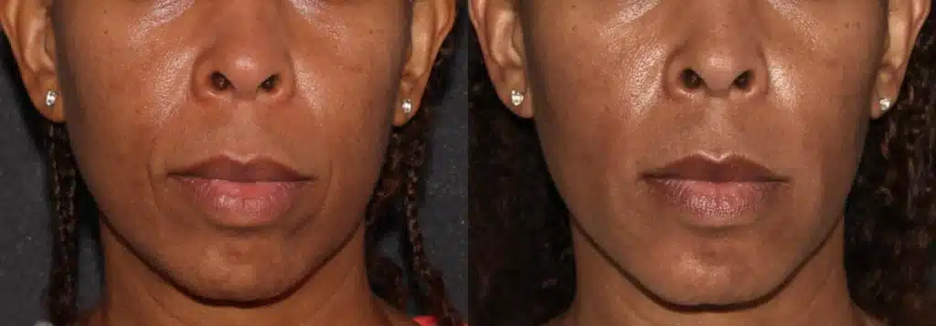 Patient photo before dermal fillers