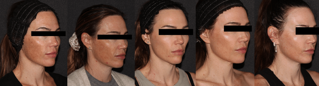 Photos of a woman before Forever Young BBL treatment