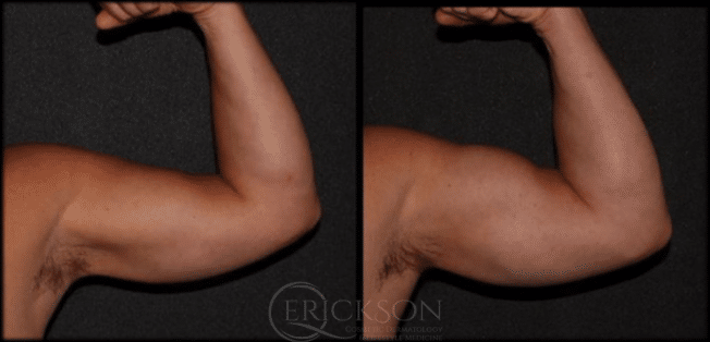 Photo of arm muscle before Emsculpt treatment