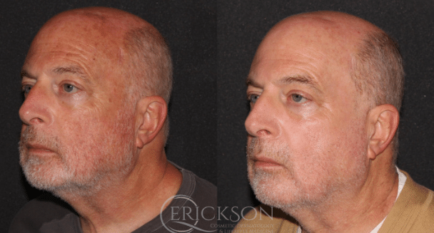 Photo of man before HALO® treatment