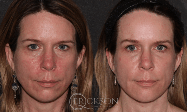 Halo Before and After Photo by Dr. Erickson in Chicago, IL Halo Before and After Photo by Dr. Erickson in Chicago, IL