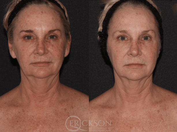 Before HALO® treatment photo of woman