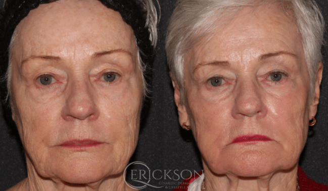 Photo of older woman before HALO® treatment