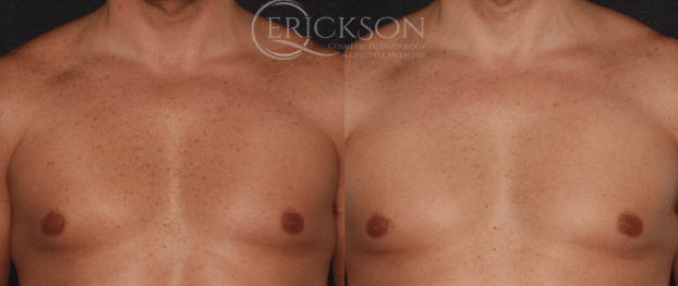 Sun damage on man’s chest before BBL treatment