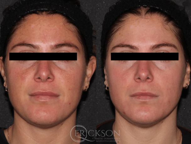 Photo of woman before MOXI treatment
