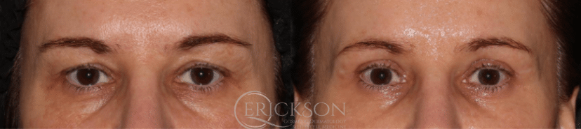 Photo of woman before blepharoplasty