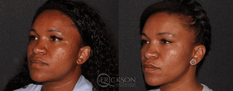 Secret™ RF Before and After Photo by Dr. Erickson in Chicago, IL