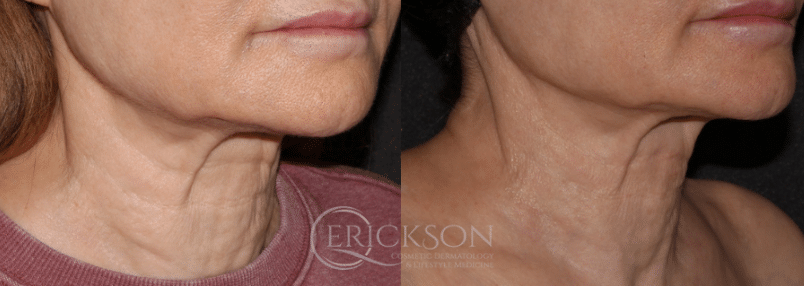 Sofwave™ Before and After Photo by Dr. Erickson in Chicago, IL Sofwave™ Before and After Photo by Dr. Erickson in Chicago, IL
