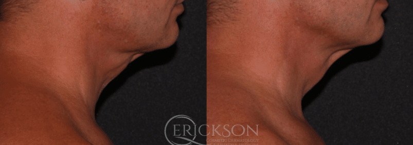 Photo of man's neck before Ultherapy®