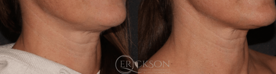 Photo of neck lines before Sofwave™