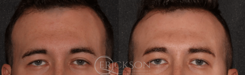 Man’s brow lift photo before Sofwave™