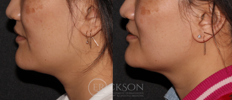 Woman’s side profile before Sofwave™ procedure