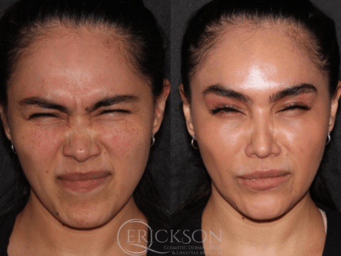 Photo taken before Botox treatment