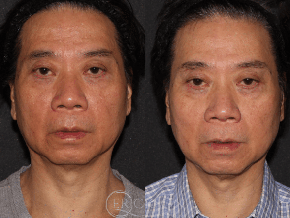 Before ClearSilk® treatment photo