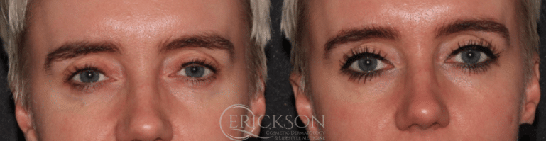 Before ClearV® treatment photo