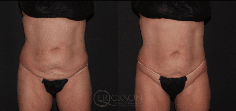 Body photo before CoolSculpting treatment