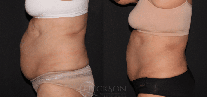 Side view photo before CoolSculpting