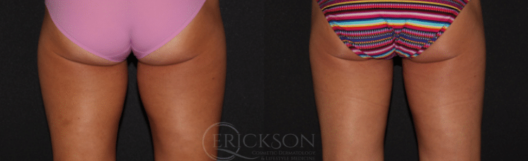 Back view photo before CoolSculpting