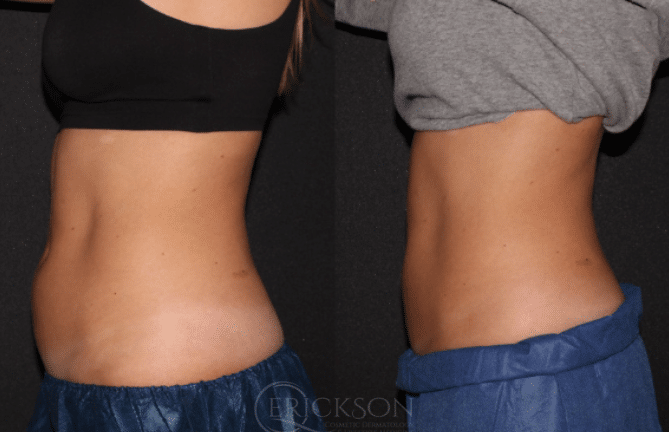 CoolSculpting Before and After Photo by Dr. Erickson in Chicago, IL CoolSculpting Before and After Photo by Dr. Erickson in Chicago, IL