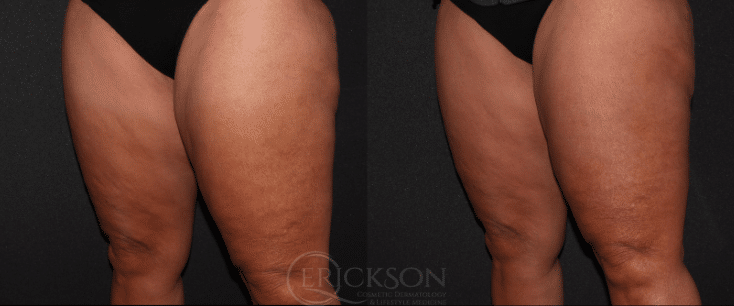 Photo of legs before CoolSculpting procedure