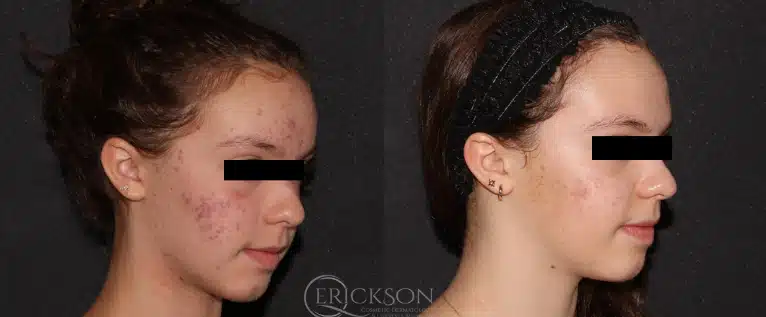 AviClear® Before and After Photo by Dr. Erickson in Chicago, IL