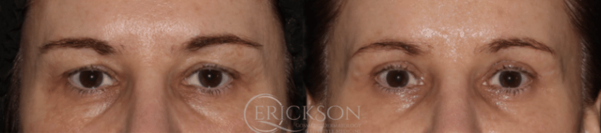 Blepharoplasty Before and After Photo by Dr. Erickson in Chicago, IL