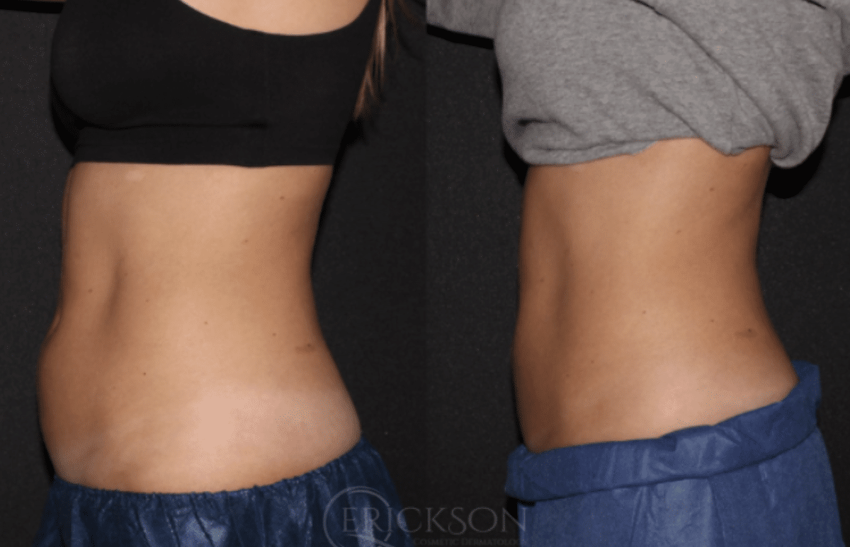 CoolSculpting Before and After Photo by Dr. Erickson in Chicago, IL