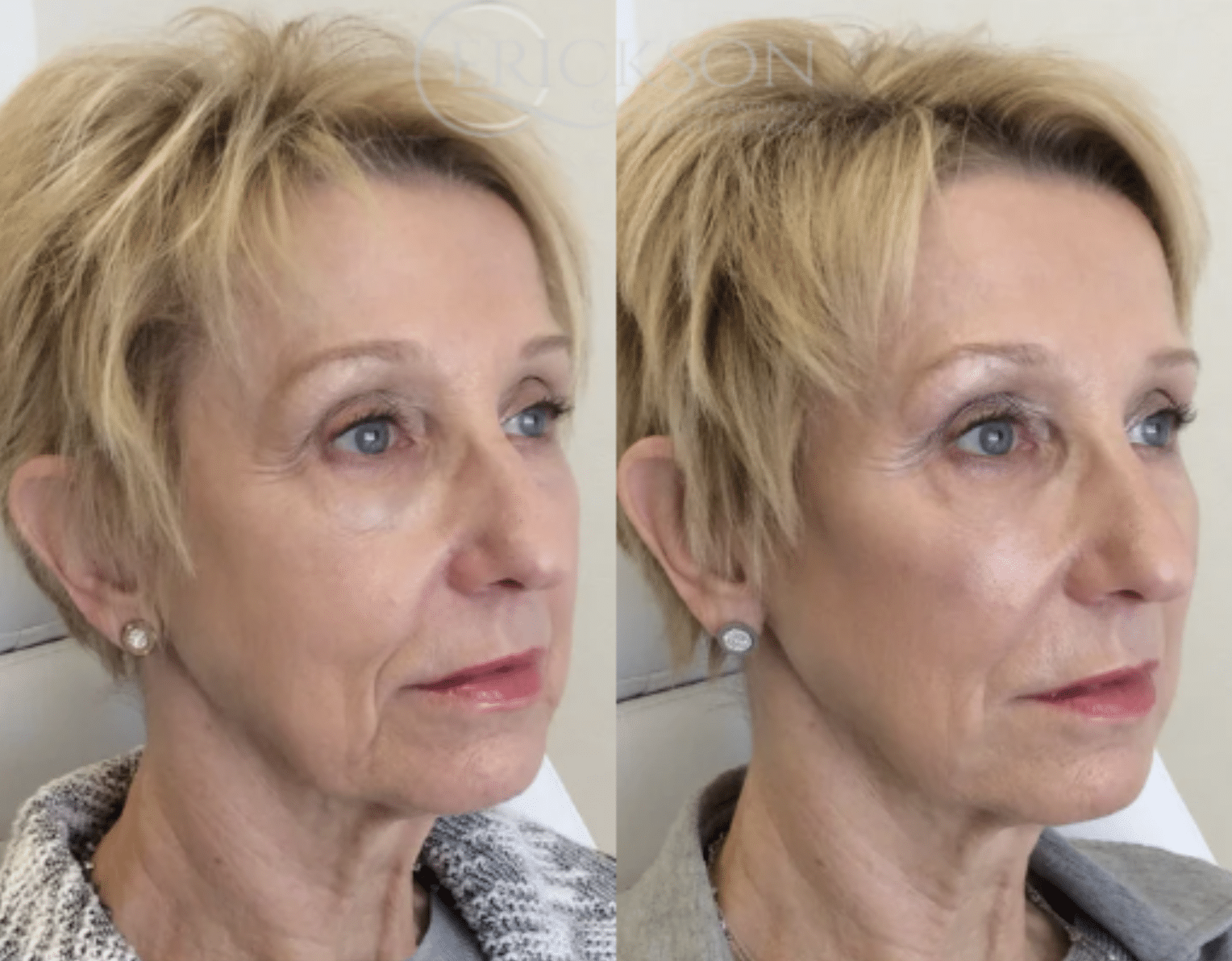 Dermal Fillers Before and After Photo by Dr. Erickson in Chicago, IL