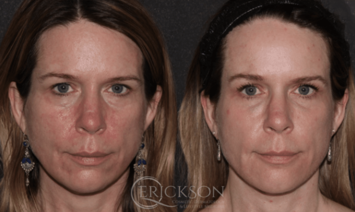 Laser Before and After Photo by Dr. Erickson in Chicago, IL
