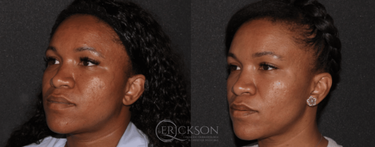 SecretRF Before and After Photo by Dr. Erickson in Chicago, IL