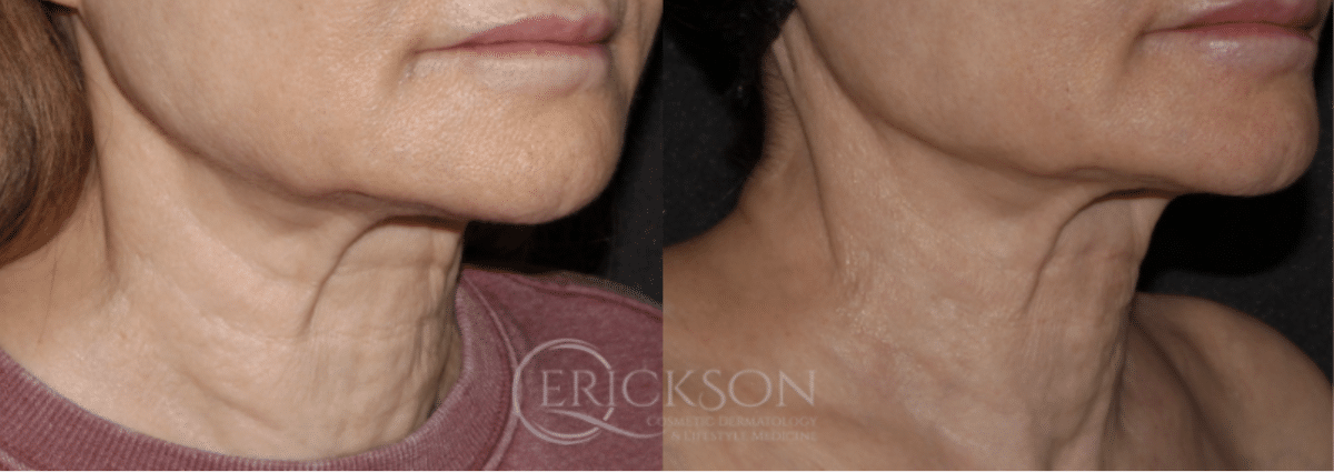 Skin Tightening Before and After Photo by Dr. Erickson in Chicago, IL