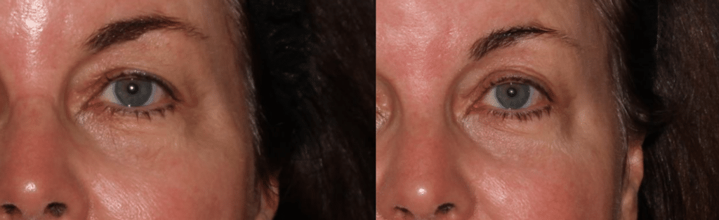 Photo of woman’s skin before Sofwave™