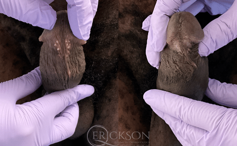 PPP (Pearly Penile Papules) Removal Before and After Photo by Dr. Erickson in Chicago, IL