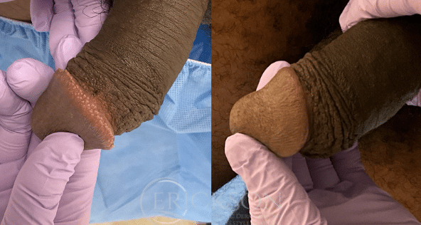 PPP (Pearly Penile Papules) Removal Before and After Photo by Dr. Erickson in Chicago, IL