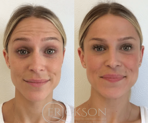 Photo of woman before Botox injections