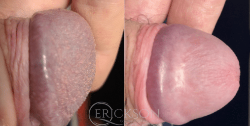 PPP Removal before and after results