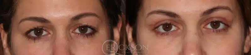 Woman’s face before blepharoplasty