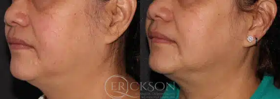 Pre-treatment photo for ClearV®