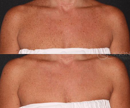 Woman’s chest photo before MOXI treatment
