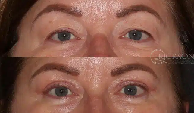 Female patient before blepharoplasty