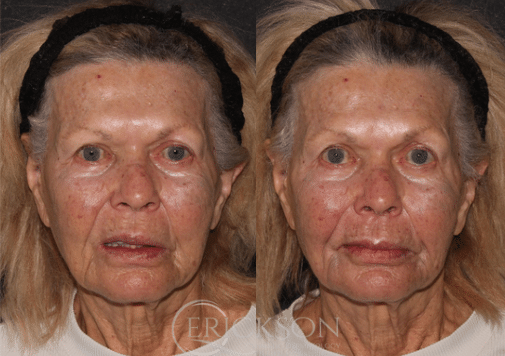 Photo showing facial lines before dermal fillers