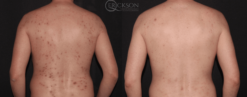 Botox Before and After Photo by Dr. Erickson in Chicago, IL Botox Before and After Photo by Dr. Erickson in Chicago, IL