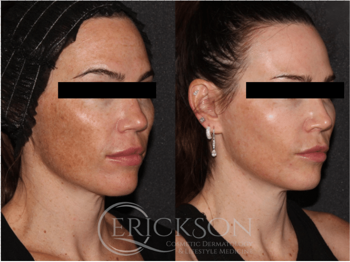BBL Face before + after results BBL Face before + after results